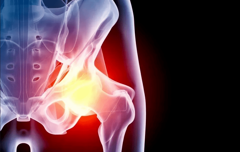 Osteoarthritis of the hip joint
