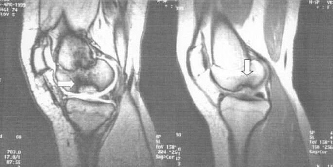 x-ray of osteochondrosis dissecans in the knee joint
