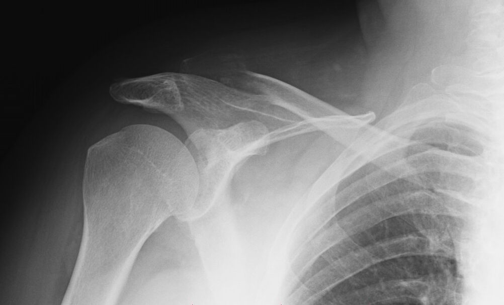 shoulder osteoarthritis x-ray