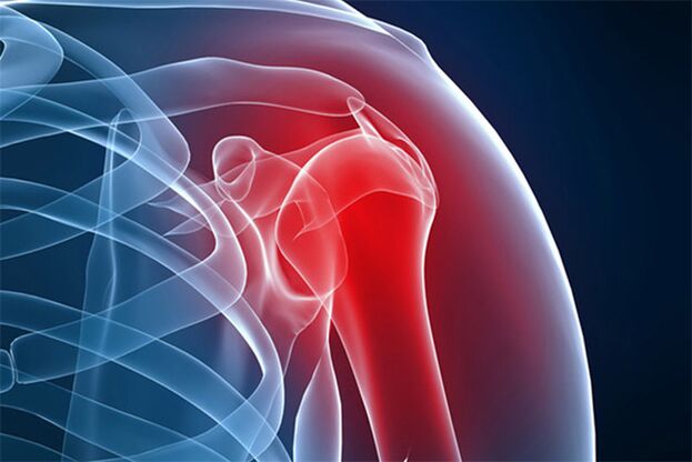 shoulder pain from osteoarthritis