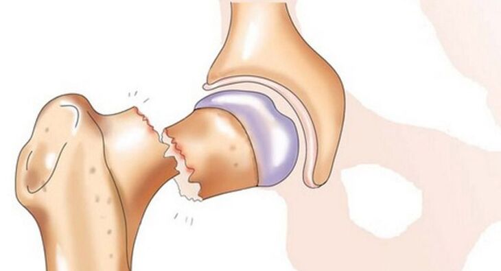 A fracture of the femoral neck is accompanied by severe pain in the hip joint. 