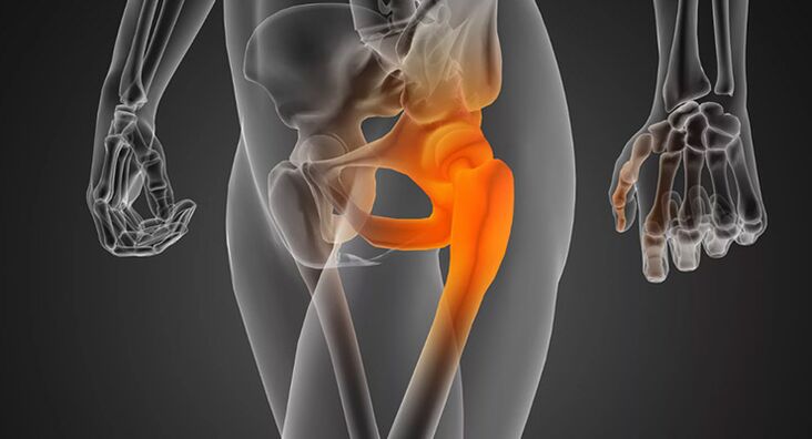 Infectious hip pain requiring antibiotic treatment. 