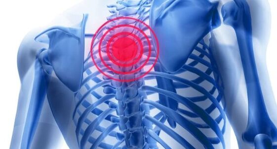 Treatment of Osteochondrosis of the thoracic column
