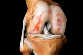 Damage to the knee joint due to osteoarthritis.