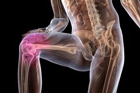 Joint pain due to knee osteoarthritis.