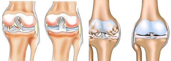 Arthritis and osteoarthritis