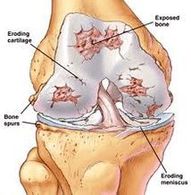 The mechanism of development of osteoarthritis